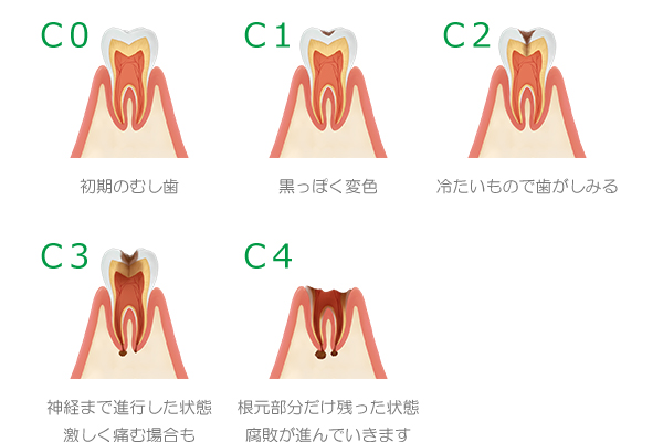 C0 初期のむし歯 - C1 黒っぽく変色 - C2 冷たいもので歯がしみる - C3 神経まで進行した状態・激しく痛む場合も - C4 根本部分だけ残った状態・腐敗が進んでいきます